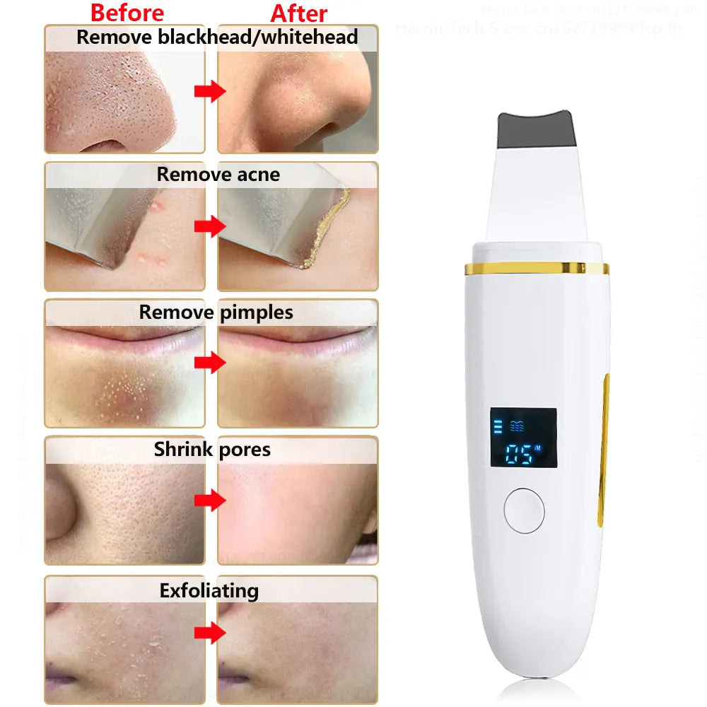 Épurateur de peau ultrasonique, dissolvant de points noirs, Peeling ultrasonique du visage 